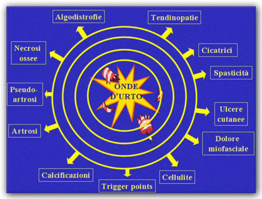 Onde d’urto – Overview (immagine tratta da www.sitod.it/terapia/linee-guida)